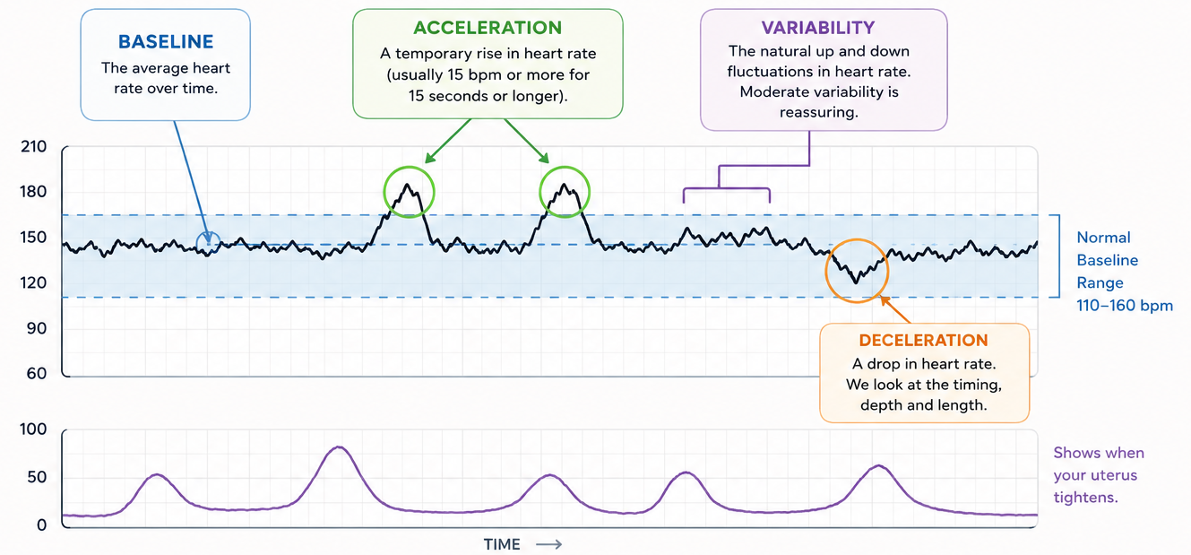 Annotated NST tracing showing baseline, accelerations, variability, and a deceleration on the fetal heart rate channel, with uterine contractions on the lower channel. A blue band marks the normal baseline range of 110–160 bpm.
